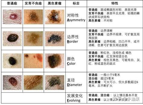 如何消痣|痣是什麼？會變成黑色素瘤？7種一定要除的痣